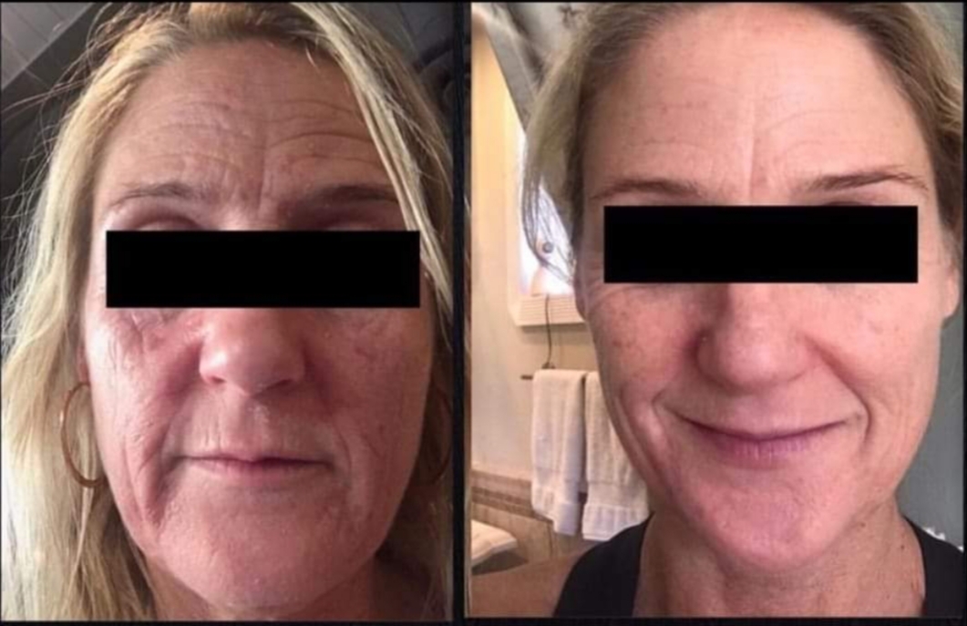 peel microderm anti-aging sun damage wrinkles